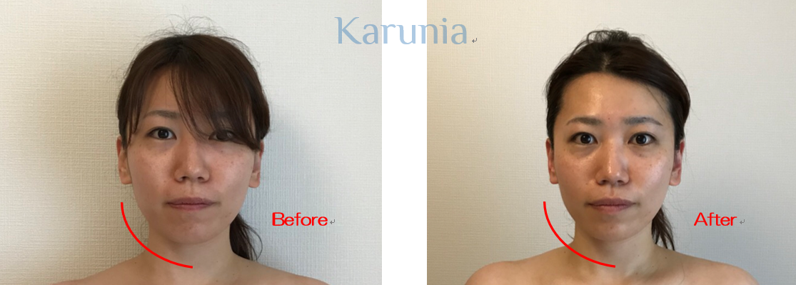 むくみ顔は顔筋ケアで解消 Karunia Health Beauty Salon